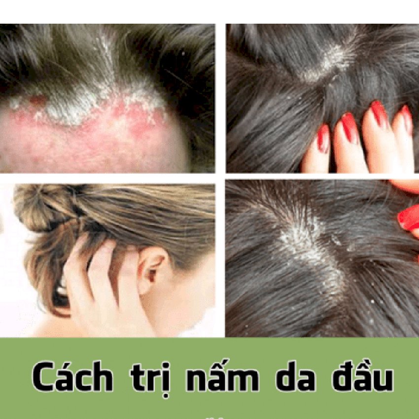 5 Bí kíp trị rụng tóc cho người bận rộn  Dược Phẩm Nam Thái Dương
